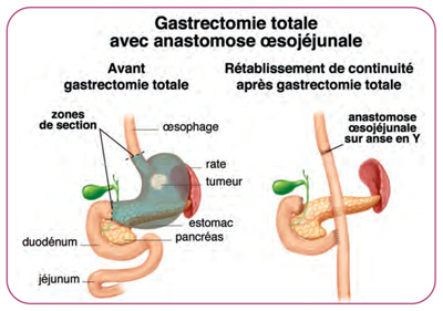 Gastrectomie totale