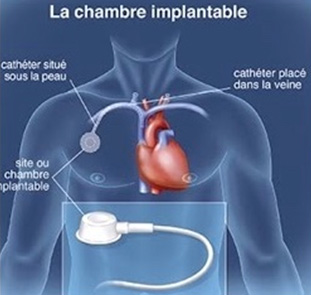 Chambre implantable 2