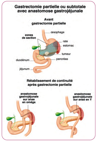 Gastrectomie partielle