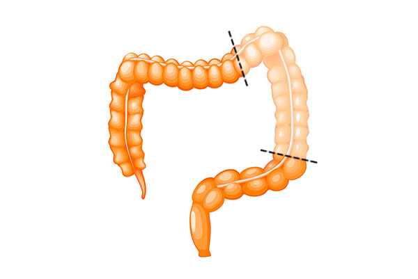 Diverticulose colique et sigmoidite Valence | Centre de Chirurgie ...